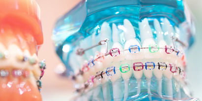 Bagues Inventaire des appareils dentaires disponibles? Baques: Les orthodontistes et spécialistes de la chirurgie maxillo-faciale vous diront tout ce qu’il faut savoir pour faire le bon choix parmi toutes les solutions et méthodes correctrices existantes. Les modèles d’appareils dentaires suivants sont les plus répandus en Suisse :