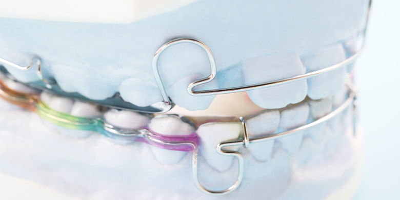 Attivatore Monoblocco Il monoblocco viene utilizzato per l'intera correzione. Allunga e posiziona la mascella, quindi posiziona i denti. La correzione richiede molto tempo e la collaborazione di chi la indossa. I costi totali della correzione ammontano a circa 3'500-10'000 franchi.