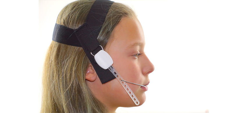 Headgear L'Headgear e non è un metodo di correzione finale. Serve, ad esempio, come prima fase del trattamento in caso di morso incrociato o overbite. Dopo il riposizionamento, il posizionamento finale del dente viene eseguito con le brackets. Il tempo medio di utilizzo al giorno è di 14 - 16 ore.